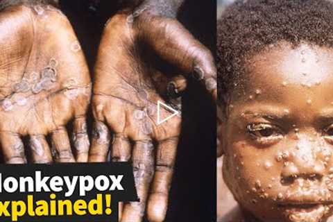 5 Things You Need to Know about Monkeypox Right Now!