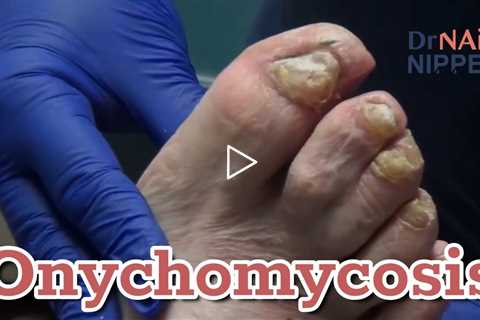 Throwback - Doc Returns, Thick Toenails, Onychomycosis