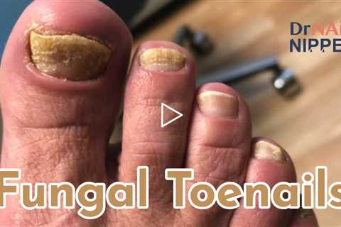 Fungal Toenails. FEET-ure Friday (2022)