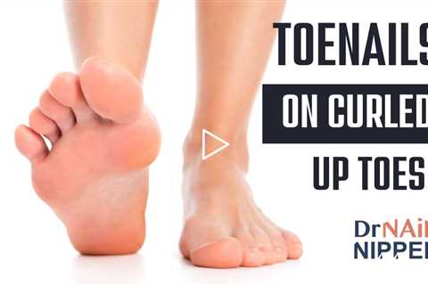 Toenails on curled up toes.  How does Foot Pain hurt?  FF (2022)