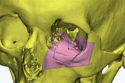 Physicians utilize 3D printing to rebuild the eye socket of a client from the United Arab Emirates