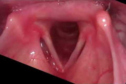 Vocal cord motion during breathing