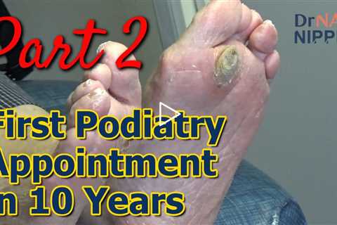 Monster Callus - First Podiatry Appointment in 10 Years, Part 2.  Callus Tuesday (2023)