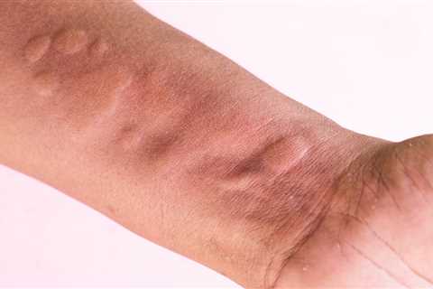 FDA reviews biologics license application for Dupixent for chronic spontaneous urticaria