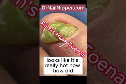 Dr Nail Nipper ➡️ Great Big Ram's Horn Nails on Big Toes #foothealth #nailnipper #drnailnipper