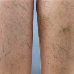 Treating Vein Diseases in St. Louis, Missouri: Supplements and Other Options