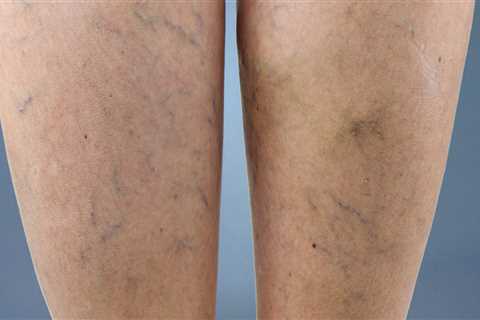 Treating Vein Diseases in St. Louis, Missouri: Supplements and Other Options