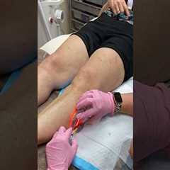 Ultrasound-Guided Sclerotherapy: A Successful Treatment for Vein Diseases in St. Louis, Missouri