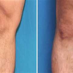 What is the Cost of Endovenous Laser Ablation Treatment for Treating Vein Diseases in St. Louis,..