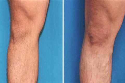 What is the Cost of Endovenous Laser Ablation Treatment for Treating Vein Diseases in St. Louis,..