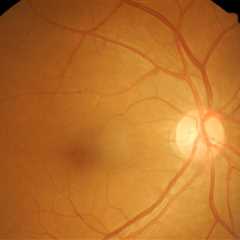 Consider possibility of infection, syphilis when managing uveitis