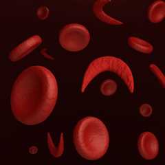 Despite safety concerns, gene therapies clinically beneficial for sickle cell disease