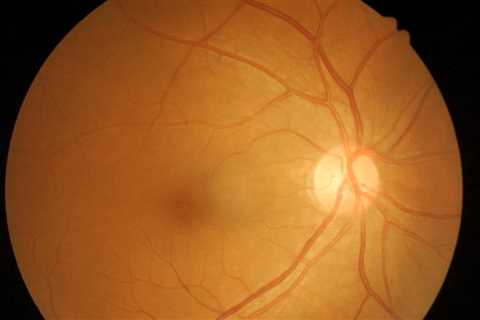 Consider possibility of infection, syphilis when managing uveitis