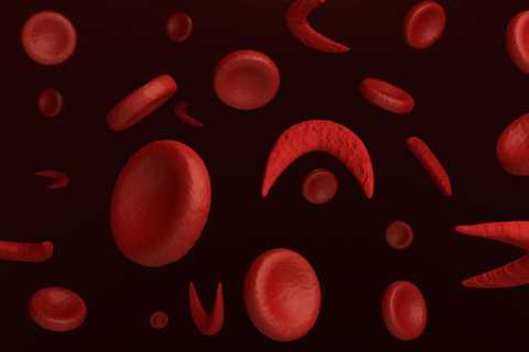 Despite safety concerns, gene therapies clinically beneficial for sickle cell disease