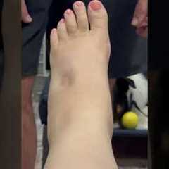 Pregnant Woman Shocked At Foot Swelling