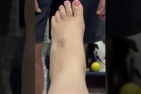 Pregnant Woman Shocked At Foot Swelling