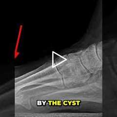 Uncovering the Shocking Truth Cyst Revealed in Arthritic Toe #CystPop #arthritic