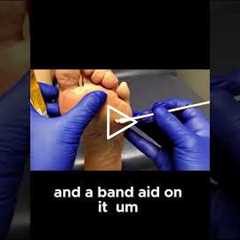 The Painful Reality of Neglected Callus and How to Fix Them #callusremoval