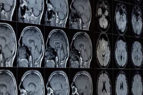 Lithium Loss in Our Brains Could Fuel Alzheimer’s, Study Reveals