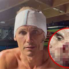 Jamie Mitchell’s Gruesome Wipeout Cuts: A Surfer’s Tale