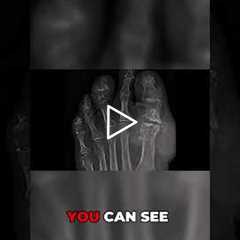 Long-Term Effects of Gout on Joints