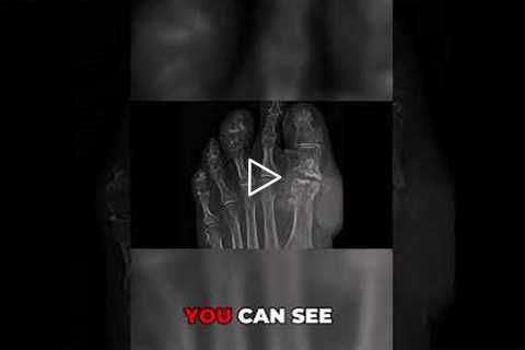 Long-Term Effects of Gout on Joints