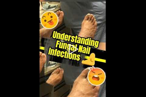 Why This Nail Problem Keeps Coming Back | Understanding Fungal Nail Infections 🦶