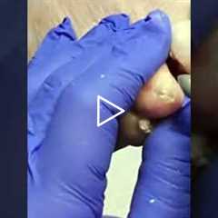 ✨ The Final Step: Polishing a Podiatrist’s Work 👣🩺