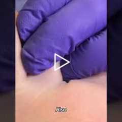 Athletes: Are Your Toenails Causing Hidden Damage?