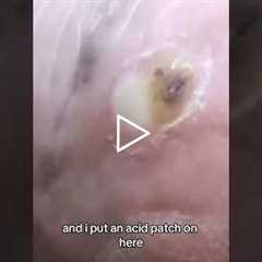 Freezing vs. Acid for Warts - What Happens When Treatment Spreads?