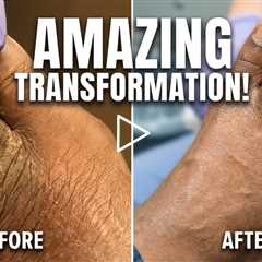 Athlete’s Foot Found During Routine Nail Trim 👣