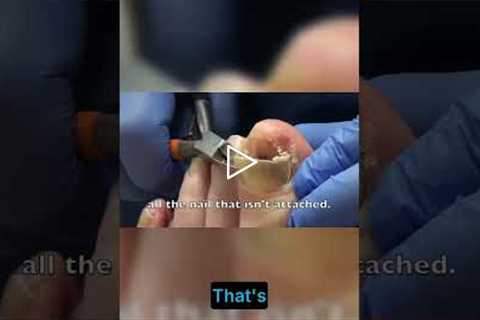 Nail Care Tips Avoiding Common Mistakes  #podiatry #foothealth #drnailnipper