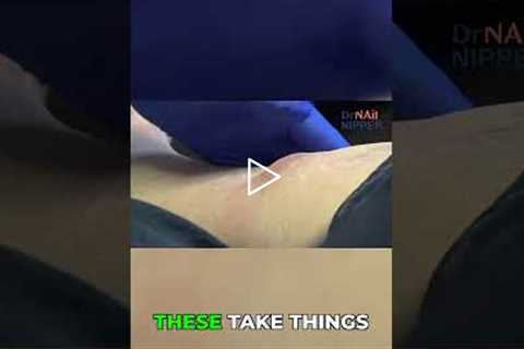 Understanding Hematomas and Healing Time