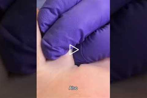 Athletes: Are Your Toenails Causing Hidden Damage?