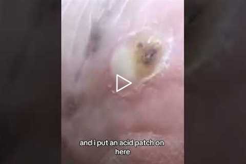 Freezing vs. Acid for Warts - What Happens When Treatment Spreads?