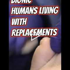 Bionic Patients & Neuropathy Talk: What to Watch For