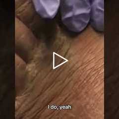 Routine Toenail Trim… and We Found Athlete’s Foot! | Podiatrist Explains