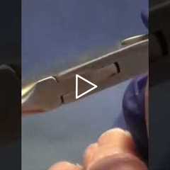 The Painful Callus A Foot Doctor's Perspective | Painful Callus Relief in Minutes 👣