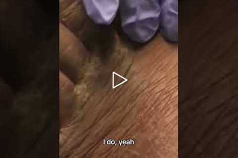 Routine Toenail Trim… and We Found Athlete’s Foot! | Podiatrist Explains