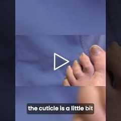 Fungal Treatment Success Nail Growth Update 🌱