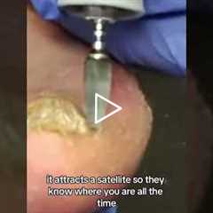 This Foot Has Screws In It! 🔩 (You Won’t Believe Why)