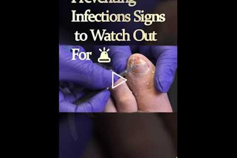 Preventing Infections Signs to Watch Out For 🚨