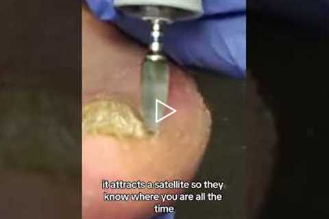 This Foot Has Screws In It! 🔩 (You Won’t Believe Why)
