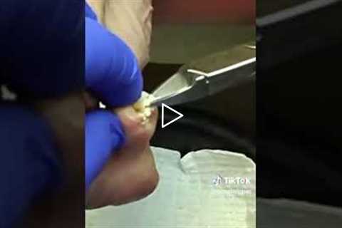 This Is Why Your Toenails Are Always Pinched