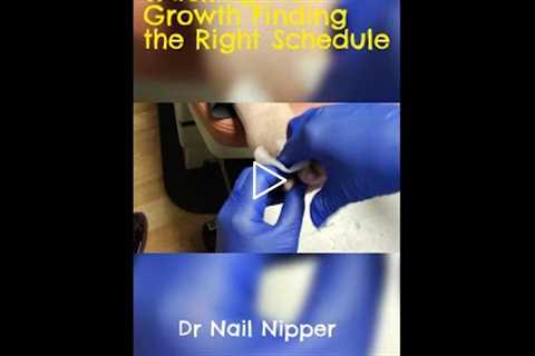 Tracking Nail Growth Finding the Right Schedule