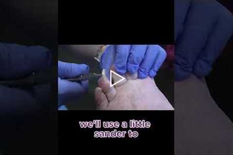 Trimming Thick Nails Like You've Never Seen #satisfying #asmr