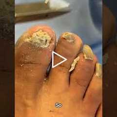 That's the thing. When you're using big nip, they're called nail nippers.  #footcare