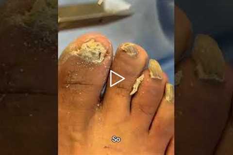 That's the thing. When you're using big nip, they're called nail nippers.  #footcare