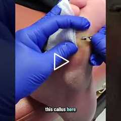 Is This Painful Foot Procedure Worth It