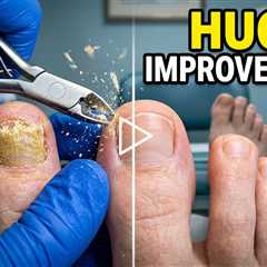 Follow-Up Toenail Treatment: How Much Improvement in One Month?